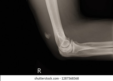 Xray Right Elbow