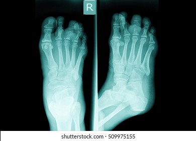 Xray Foot Fracture Stock Photo 1051999238 | Shutterstock