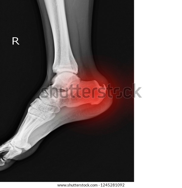 right calcaneal spur