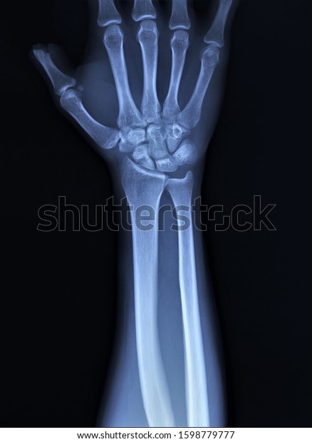 Xray Right Hand Amputation Nail Phalanx Stock Photo 1598779777 