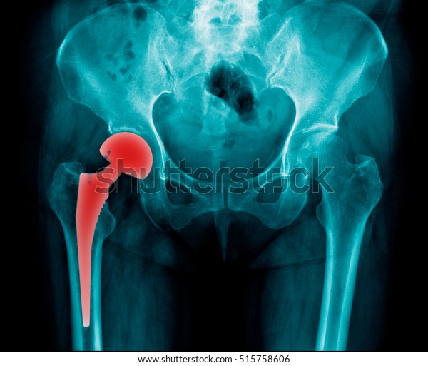 x-ray right hip\
replacement and pelvic\
bone