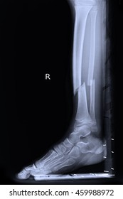 Xray Right Leg Show Closed Fracture Tibia And Fibula