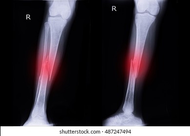 Xray Right Leg Show Fracture Tibia And Fibula