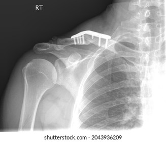 X-ray Of Right Shoulder With Broken Collar Bone And Metal Plate