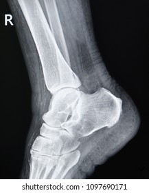 184 Ankle ct scan Images, Stock Photos & Vectors | Shutterstock