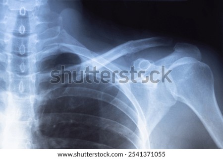 X-ray scan of  Dislocation of the acromial end of the clavicle.