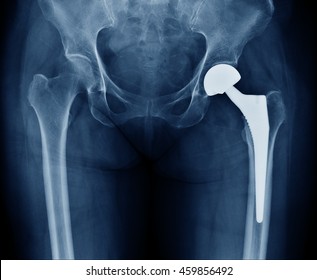 [Image: xray-scan-image-hip-joints-260nw-459856492.jpg]