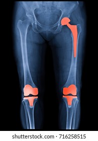 Xray Scan Of Patient Who Have Hip Replacement And Knee Arthroplasty (knee Replacement) Treatment For Osteoarthritis Knee, Hip Arthritis, Osteonecrosis Of Hip. After Surgery Patient Can Walk Normally.