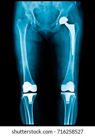 Xray Scan Of Patient Who Have Hip Replacement And Knee Arthroplasty (knee Replacement) Treatment For Osteoarthritis Knee, Hip Arthritis, Osteonecrosis Of Hip. After Surgery Patient Can Walk Normally.