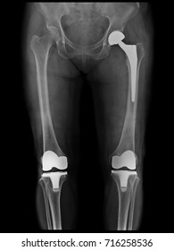 Xray Scan Of Patient Who Have Hip Replacement And Knee Arthroplasty (knee Replacement) Treatment For Osteoarthritis Knee, Hip Arthritis, Osteonecrosis Of Hip. After Surgery Patient Can Walk Normally.