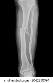 Xray Of Segmented  Bone Fracture