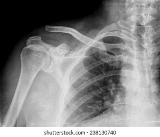 Xray Of Shoulder