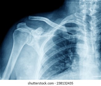 Xray Of Shoulder