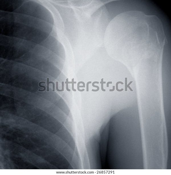shoulder xray shoulder xray