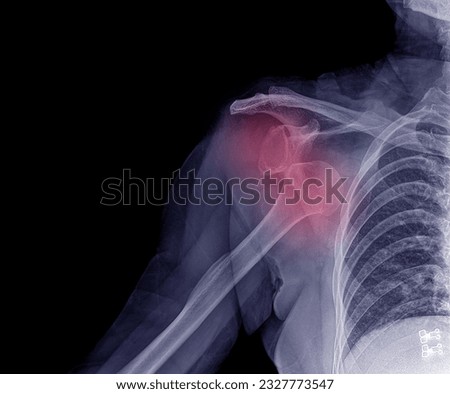 X-ray of the shoulder bone of a traffic accident patient showed fractures in the shoulder area. Red represents pain, blue tones, black background.