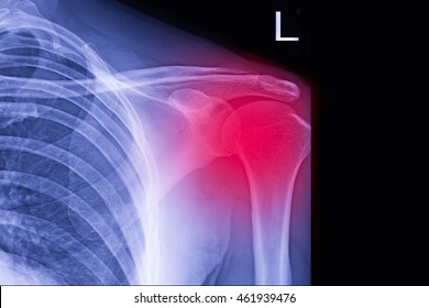 Xray Shoulder : Frozen Shoulder Left