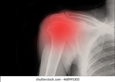 Xray Shoulder : Frozen Shoulder Left