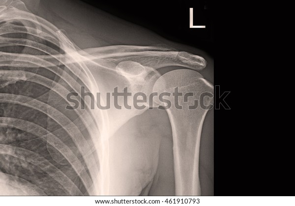 Xray Shoulder Frozen Shoulder Left Stock Photo (Edit Now) 461910793