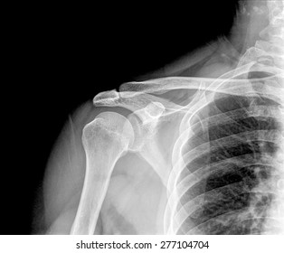 Xray Shoulder Joint Stock Photo 277104704 | Shutterstock