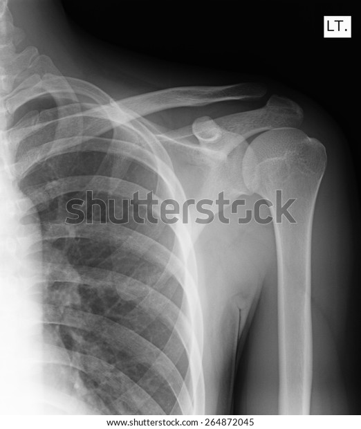 Xray Shoulder Joint Stock Photo 264872045 | Shutterstock