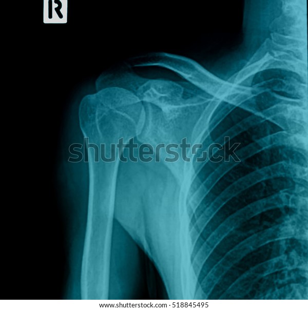 Xray Shoulder Joint Stock Photo (Edit Now) 518845495