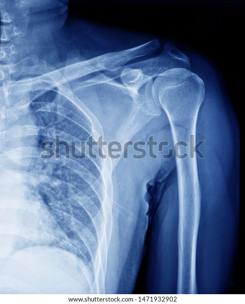 Xray Shoulder Joint Clavicle Stock Photo (Edit Now) 1471932902