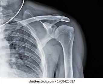 x-ray of the shoulder joint, diagnosis of bone pathology - Shutterstock ID 1708425517
