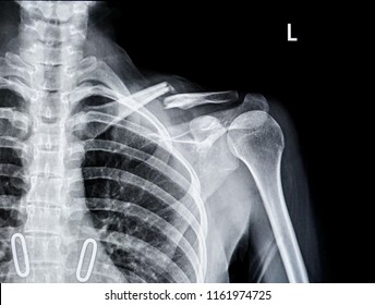 Röntgen-Röntgen-Bruchverbindung                                