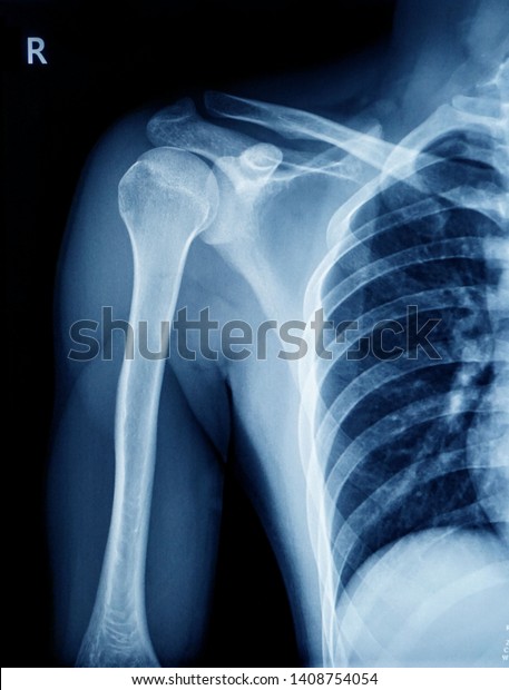 Xray Shoulder Joint Show Fracture Clavicle Stock Photo Shutterstock