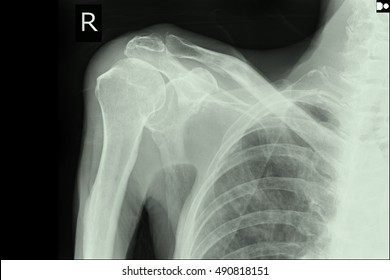 Xray Shoulder Right Fresh Frozen Shoulder Stock Photo (Edit Now) 490818130