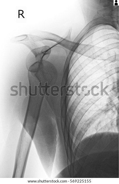 Xray Shoulder Right Frozen Shoulder Stock Photo 569225155 | Shutterstock