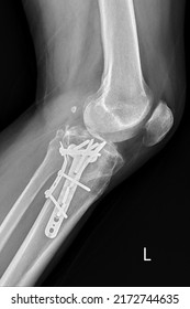 exhibición de xray fractura cerrada fémur izquierdo y postoperatorio