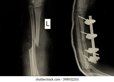 X-ray show closed fracture left elbow - Shutterstock ID 398932255