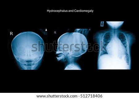 xray show hydrocephalus and cardiomegaly