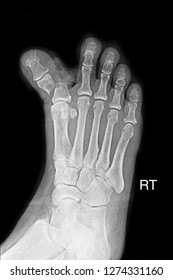 xray-show-image-closed-fracture-260nw-1274331160.jpg