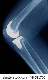X-ray Show Knee Arthroplasty / Knee Replacement
