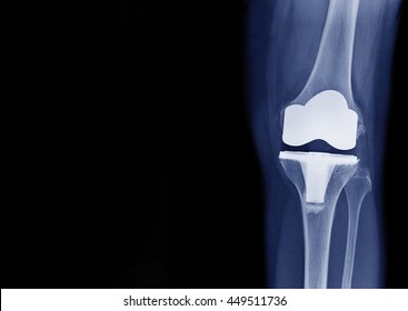 Xray Show Knee Joint Replacement Knee Stock Photo 449511736 | Shutterstock