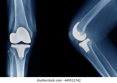 X-ray Show Knee Joint Replacement / Knee Arthroplasty Front View And Side View