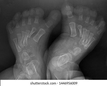 The X-ray Show Polydactyly Of 2nd Toe And Varus Deformity Of Both Feet.