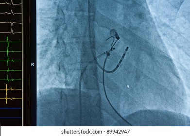 Xray showing the correct placement of catheter ablation for atrial fibrillation