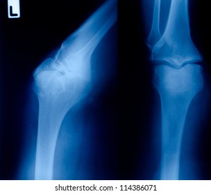 Xray Showing Right Knee Osteoarthritis