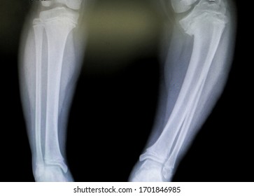 A X-ray Is Shown A Late Blount's Disease Of Leg. It's Depression Of Medial Metaphysis Of Tibial Plateau But Not Closured Physis. It's Severe Varus Deformity Of The Leg.