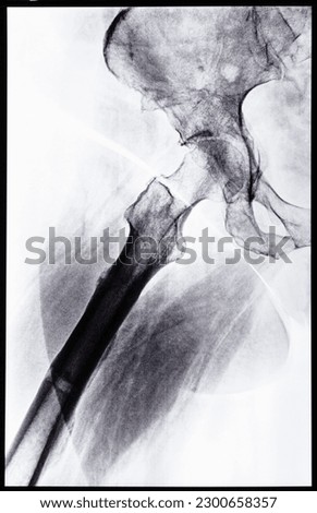 x-ray side view of junction of tibia and pelvis after healed of fracture of acetabular cavity