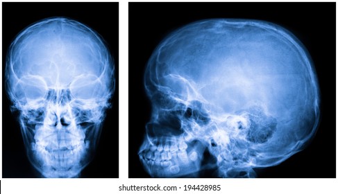 X-ray Of The Skul