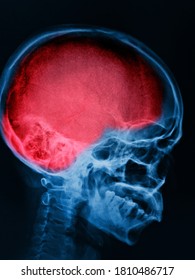 X-ray  Skull And Cervical Spine Mild Head Injury