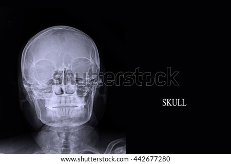 xray skull : human skull