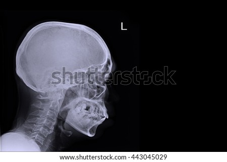 xray skull lateral