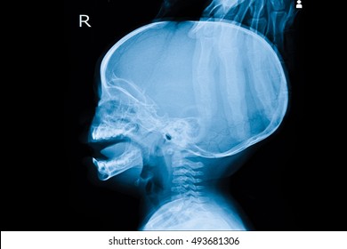 Xray Skull In Patient Young Child And Show Hydrocephalus