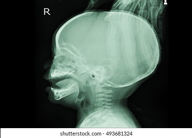 Xray Skull In Patient Young Child And Show Hydrocephalus