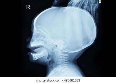 Xray Skull In Patient Young Child And Show Hydrocephalus